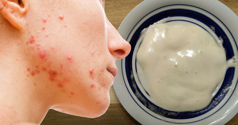 Esta mascarilla natural con ingredientes que tiene en casa ayudará a eliminar el acné y hará que tenga la piel radiante