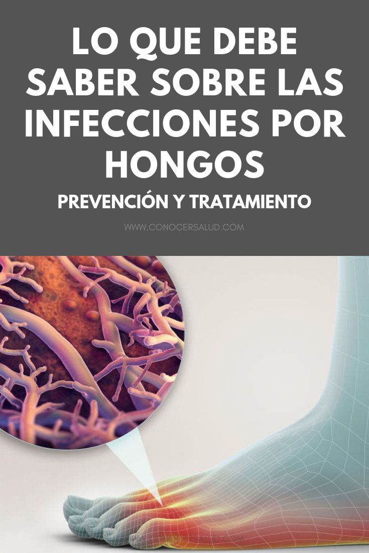 Lo que debe saber sobre las infecciones por hongos - Prevención y tratamiento