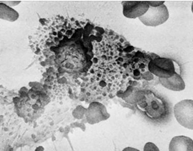 Este ingrediente común permite que las células cancerosas prosperen dentro de su cuerpo