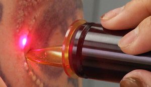 La tóxica verdad sobre los tatuajes: cicatrices, inflamación, cáncer, resonancias magnéticas