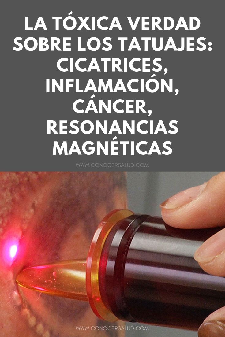 La tóxica verdad sobre los tatuajes: cicatrices, inflamación, cáncer, resonancias magnéticas