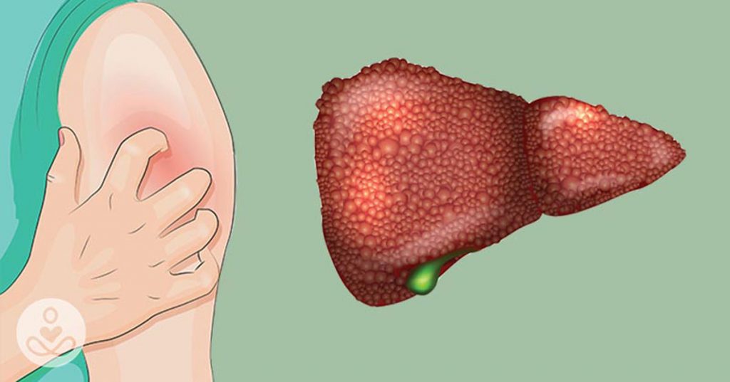 5 señales de que usted puede tener daño hepático sin siquiera saberlo