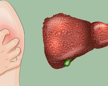 5 señales de que usted puede tener daño hepático sin siquiera saberlo