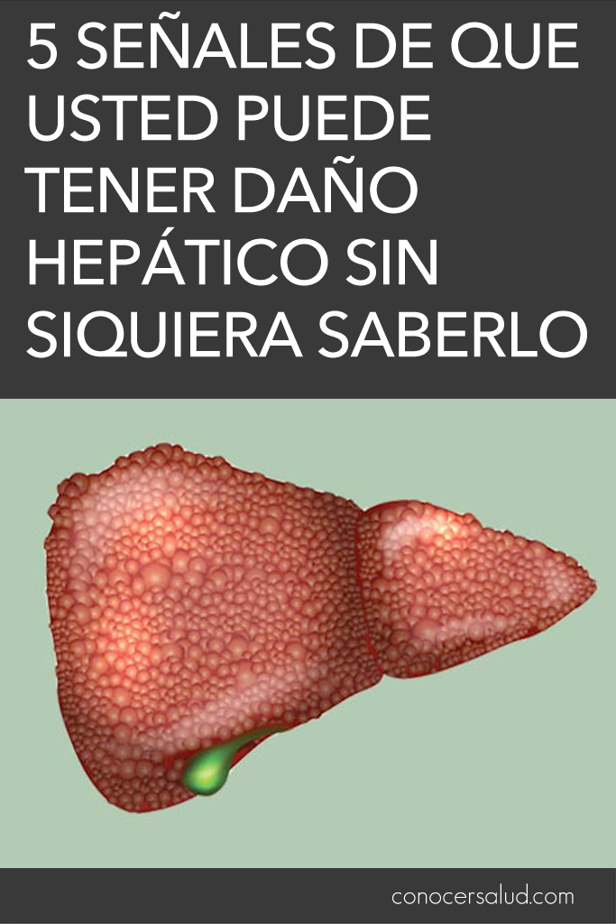 5 señales de que usted puede tener daño hepático sin siquiera saberlo