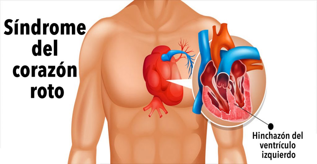 Síndrome del corazón roto: ¿Se puede morir de un corazón roto?