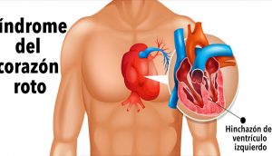 Síndrome del corazón roto: ¿Se puede morir de un corazón roto?