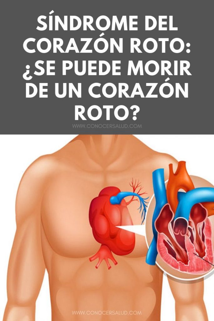 Síndrome del corazón roto: ¿Se puede morir de un corazón roto?