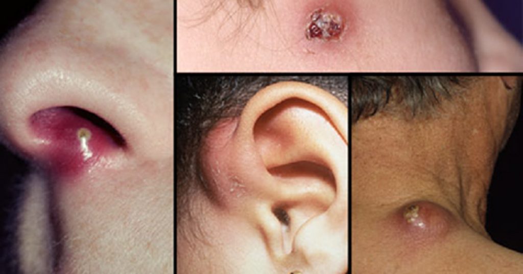 Diferentes tipos de furúnculos: síntomas, causas y tratamientos para estas dolorosas infecciones de la piel