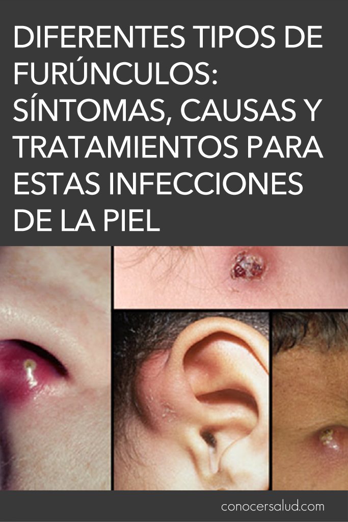 Diferentes tipos de furúnculos: síntomas, causas y tratamientos para estas dolorosas infecciones de la piel