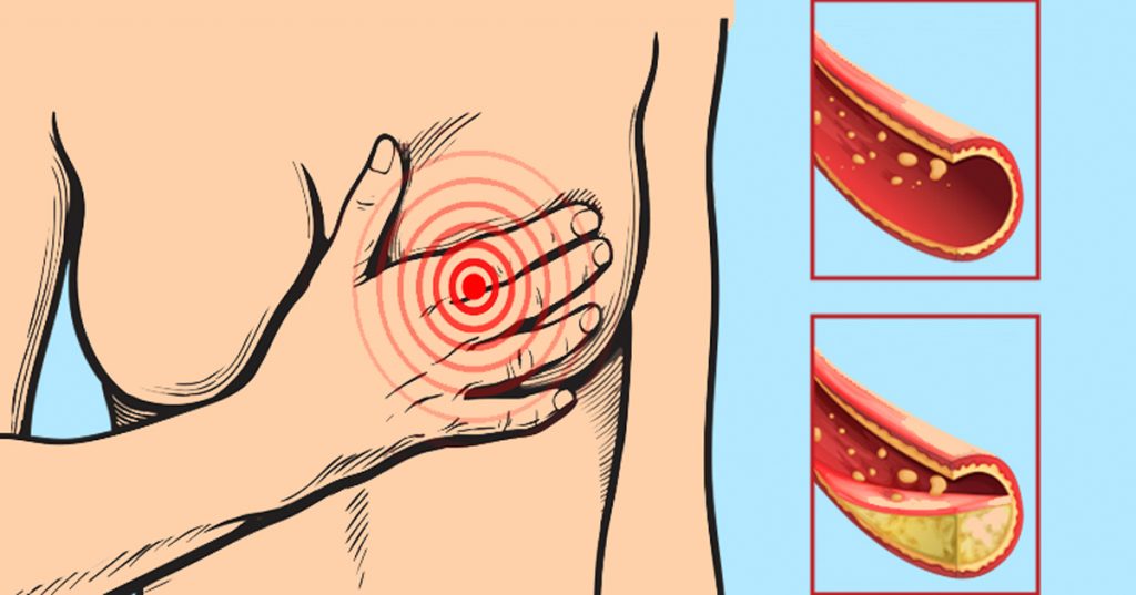12 alimentos que debe consumir diariamente para tener las arterias limpias y no obstruidas