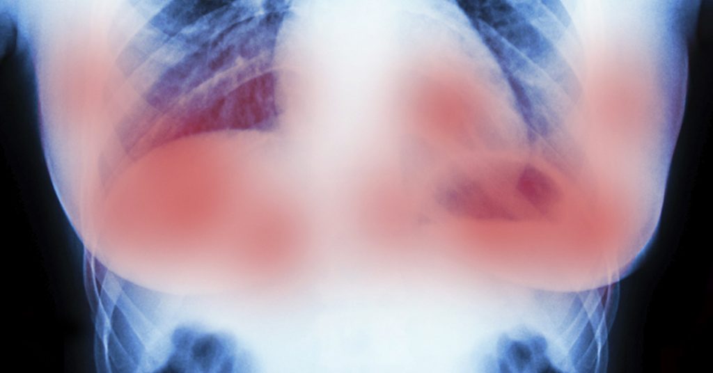 Científicos de Europa destruyen tumores de cáncer de mama en 11 días SIN quimioterapia