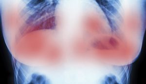 Científicos de Europa destruyen tumores de cáncer de mama en 11 días SIN quimioterapia