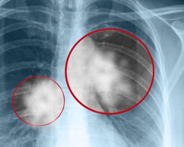 9 cosas ocultas que aumentan significativamente su riesgo de cáncer 9 cosas ocultas que aumentan significativamente su riesgo de cáncer