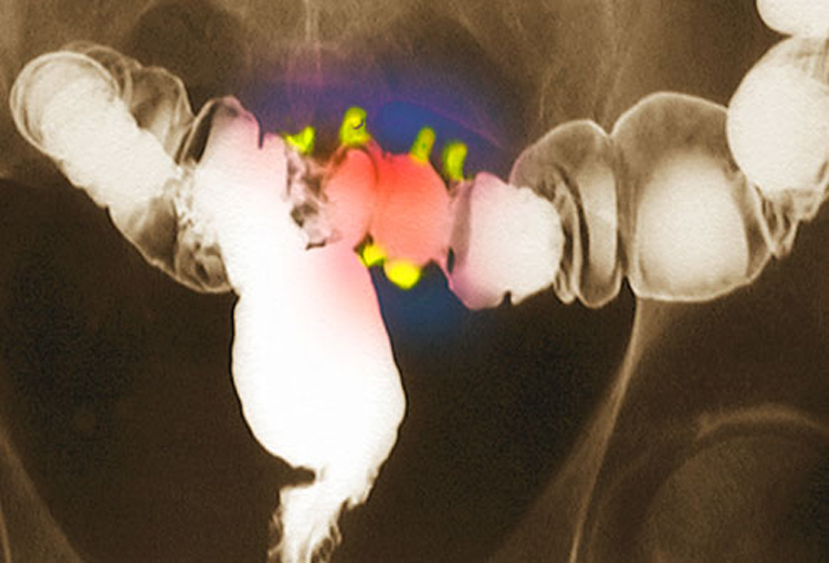 ¿Qué es la diverticulitis? Causas, síntomas y tratamientos