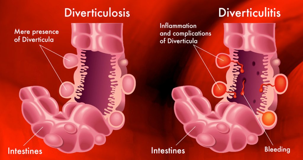 ¿Qué es la diverticulitis? Causas, síntomas y tratamientos