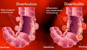 ¿Qué es la diverticulitis? Causas, síntomas y tratamientos