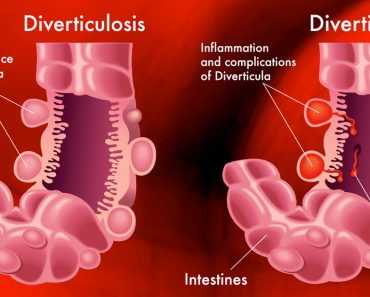 ¿Qué es la diverticulitis? Causas, síntomas y tratamientos