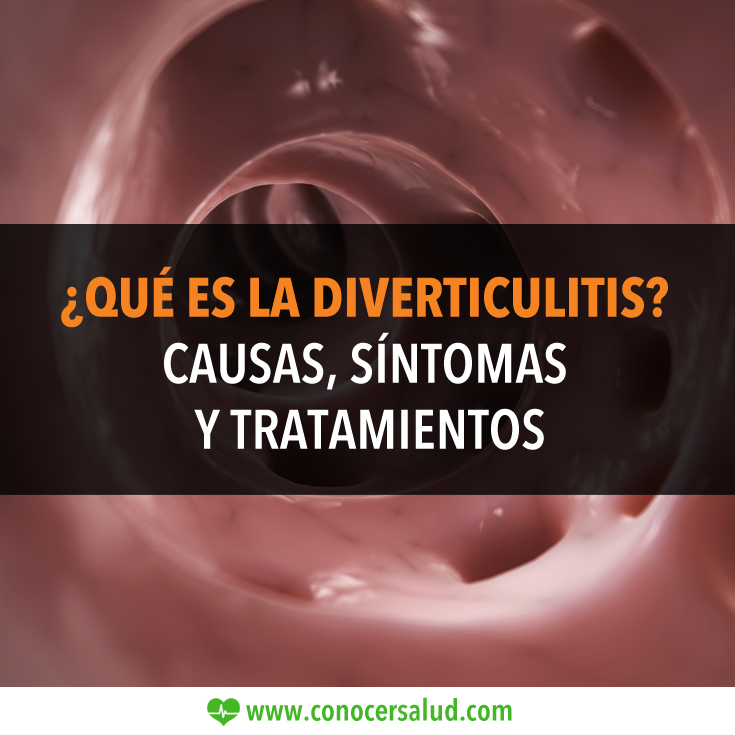 ¿Qué es la diverticulitis? Causas, síntomas y tratamientos