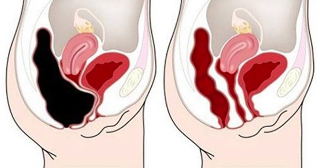 Cómo eliminar los desechos de su colon rápidamente y con seguridad