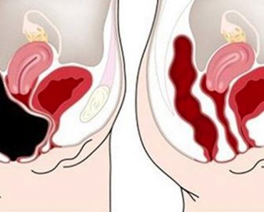 Cómo eliminar los desechos de su colon rápidamente y con seguridad