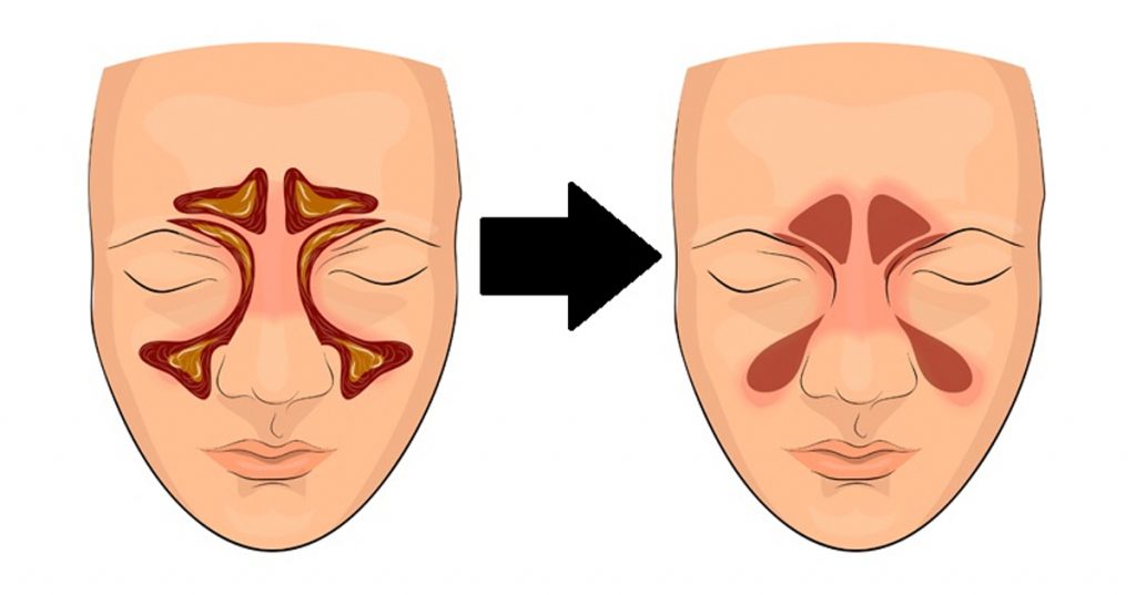 Cómo limpiar tus senos paranasales en 4 pasos con esta simple técnica