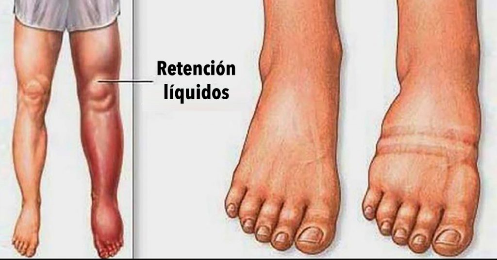 Fluid Retention