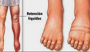 Fluid Retention