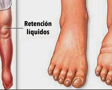 Fluid Retention