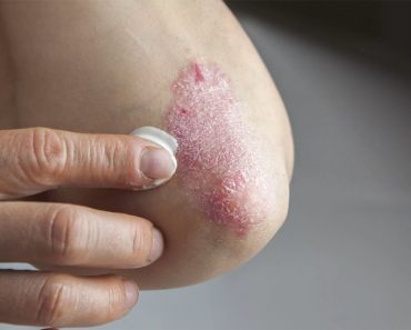 Lo que tu piel dice sobre tu salud: 8 afecciones de la piel y sus enfermedades relacionadas