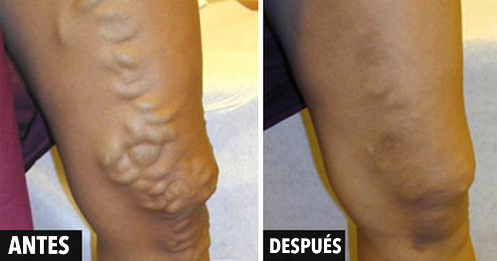 9 remedios que tratan las varices o venas varicosas sin cirugía