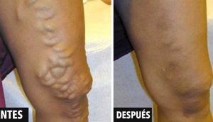 9 remedios que tratan las varices o venas varicosas sin cirugía