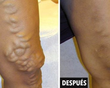 9 remedios que tratan las varices o venas varicosas sin cirugía