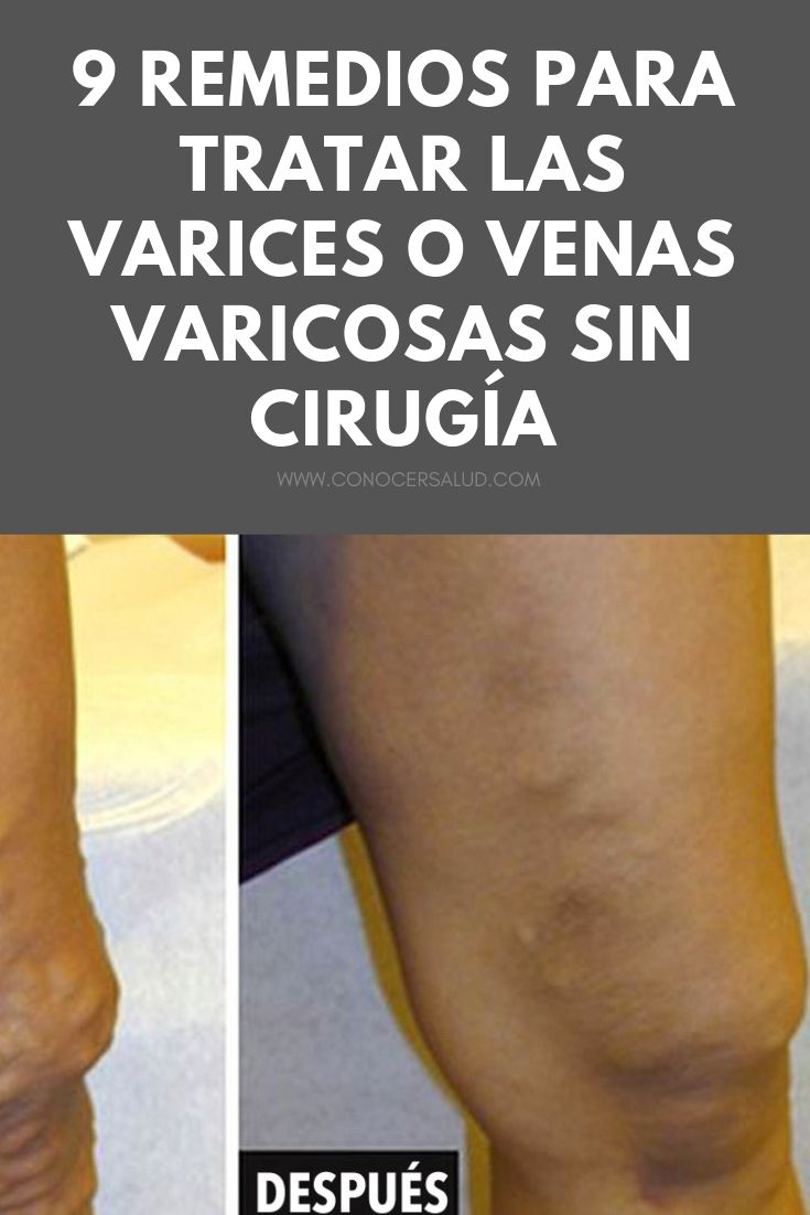 9 remedios para tratar las varices o venas varicosas sin cirugía