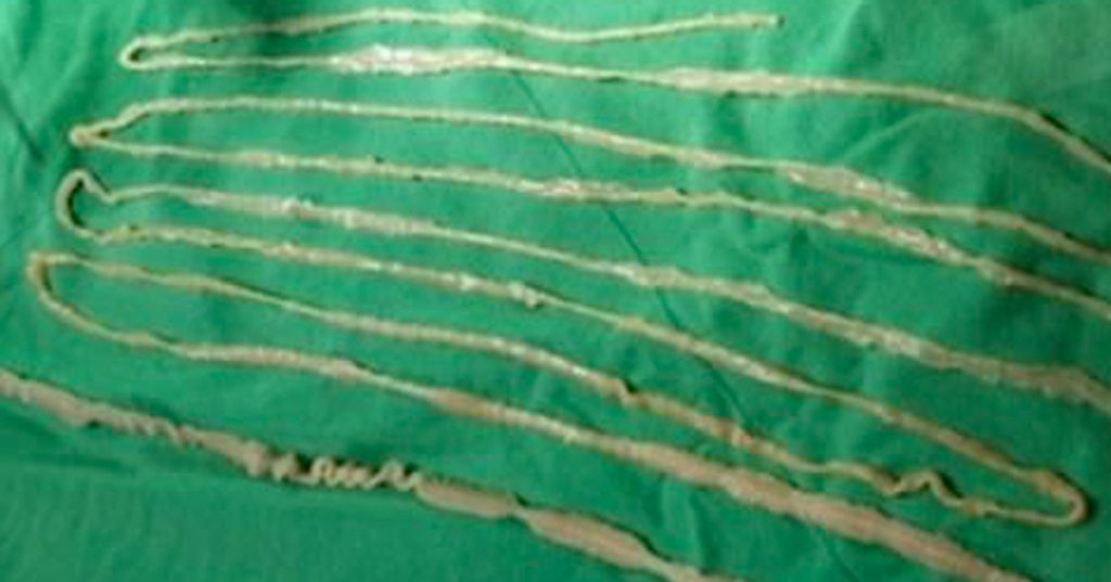Niña infectada con una tenia de más de 2 metros de larga después de comer este popular alimento