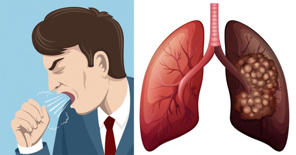 7 síntomas del cáncer de pulmón