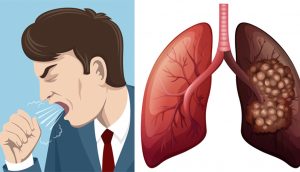 7 síntomas del cáncer de pulmón