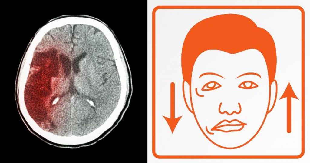 5 Síntomas de alerta de un derrame cerebral que nunca debe ignorar