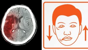 5 Síntomas de alerta de un derrame cerebral que nunca debe ignorar