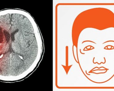 5 Síntomas de alerta de un derrame cerebral que nunca debe ignorar