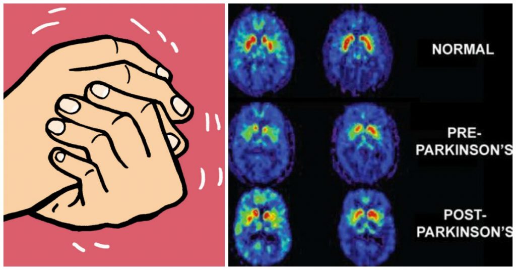 9 síntomas tempranos de la enfermedad de Parkinson que nunca debería ignorar