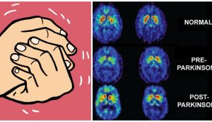 9 síntomas tempranos de la enfermedad de Parkinson que nunca debería ignorar