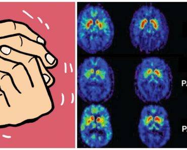 9 síntomas tempranos de la enfermedad de Parkinson que nunca debería ignorar