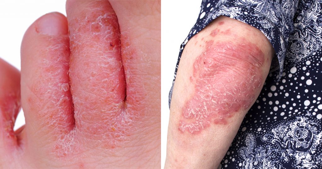 El aceite esencial que trata la psoriasis, las verrugas y el pie de atleta