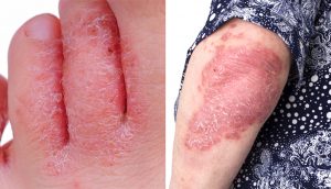 El aceite esencial que trata la psoriasis, las verrugas y el pie de atleta