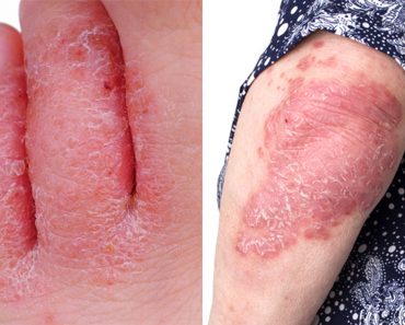 El aceite esencial que trata la psoriasis, las verrugas y el pie de atleta