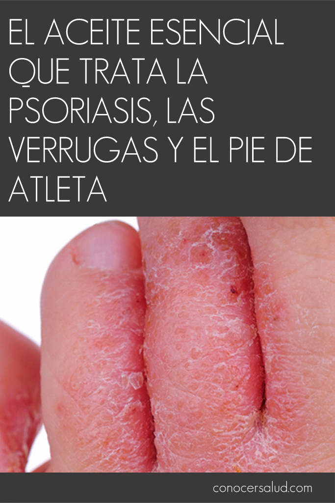 El aceite esencial que trata la psoriasis, las verrugas y el pie de atleta