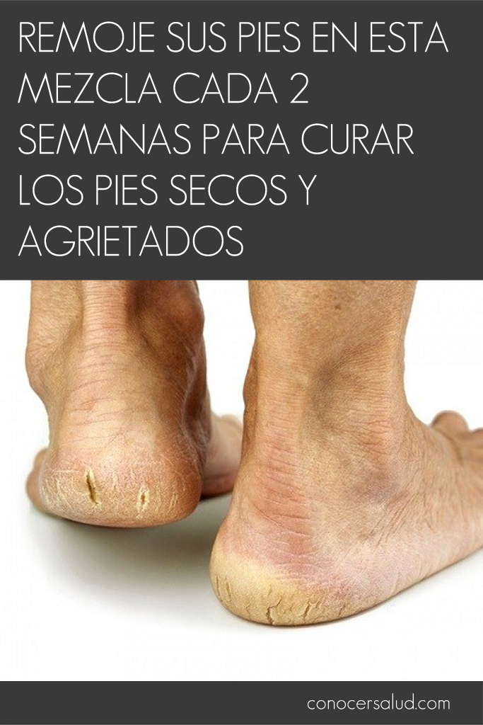 Remoje sus pies en esta mezcla cada 2 semanas para curar los pies secos y agrietados