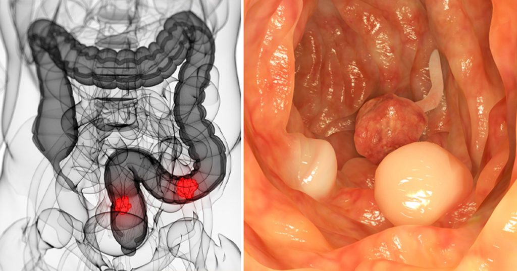 Según una investigación, éste compuesto de frutas mata las células madre del cáncer