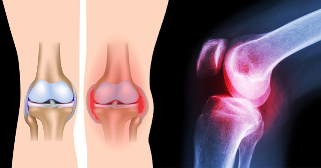 3 ejercicios simples que curan el dolor de rodilla sin cirugía o medicación