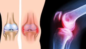 3 ejercicios simples que curan el dolor de rodilla sin cirugía o medicación